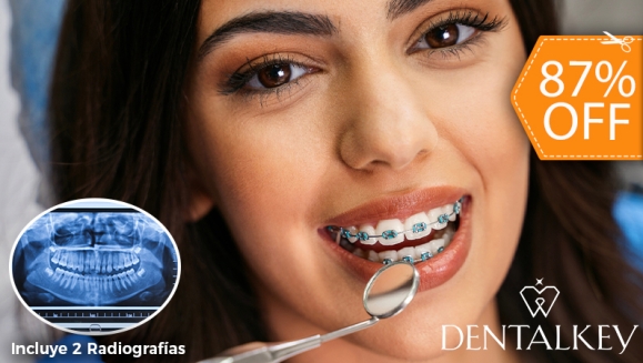 [Imagen:¡Paga $35 en Lugar de $273 por Colocación de Brackets Metálicos (Superiores e Inferiores) + Evaluación  General y Especializada para Ortodoncia + Limpieza Dental +  2 Radiografías (Panorámica y Cefalométrica) + Análisis Cefalométrico!]