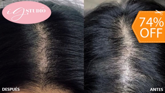 [Imagen:¡Paga $65 en Lugar de $250 por Una Sesión de Microblading Capilar en el Área Frontal, Coronilla o Barba + Retoque!]