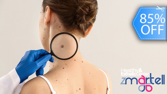 [Imagen:¡Paga Q75 en Lugar de Q500 por Cauterización Láser de hasta 10 Cabezas de Vena, 4 Lunares o 4 Verrugas (de hasta 5 mm) + Evaluación Médica!]