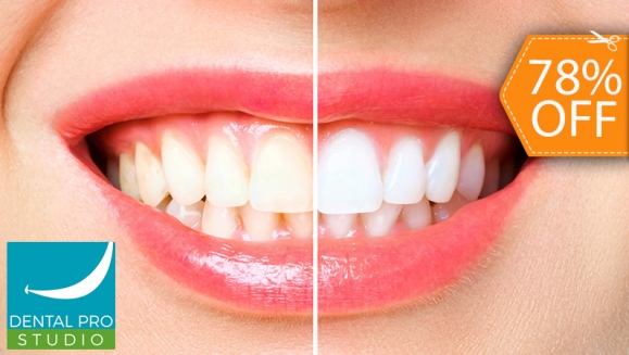 [Imagen:¡Paga $50 en Lugar de $225 por Blanqueamiento Dental Químico con Luz LED + Limpieza Profunda con Ultrasonido (Detartraje) + Consulta Odontológica + Aplicación de Refuerzo y Más!]