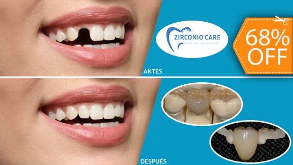 [Imagen:¡Paga $85 en Lugar de $265 por 1 Pieza Dental de Zirconio, Resina y Porcelana (Sin Metales) + Limpieza Dental con Ultrasonido + Evaluación de Cordales!]