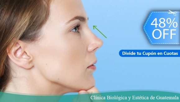 [Imagen:¡Paga Q1,049 en Lugar de Q2,000 por Respingado de Nariz con Ácido Hialurónico: Perfila, Modela y Respinga la Punta de la Nariz Sin Cirugía!]