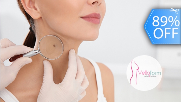 [Imagen:¡Paga Q75 en Lugar de Q700 por Cauterización Láser de hasta 20 Cabezas de Vena, 4 Lunares o 4 Verrugas (de hasta 5 mm)!]