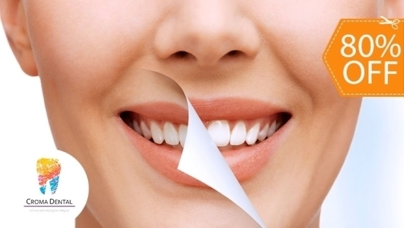 [Imagen:¡Paga $50 en Lugar de $255 por Blanqueamiento Dental Químico con Luz LED + Limpieza Profunda con Ultrasonido (Detartraje) + Consulta Odontológica!]