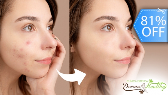 [Imagen:¡Paga Q169 en Lugar de Q900 por Terapia Clínica Anti Acné: Luz Pulsada en 2 Puntos del Rostro + Alta Frecuencia + Exfoliación Suave + Extracción de Impurezas + Mascarilla Combinada Descongestiva y Desinfectante + Serum Antimanchas!]