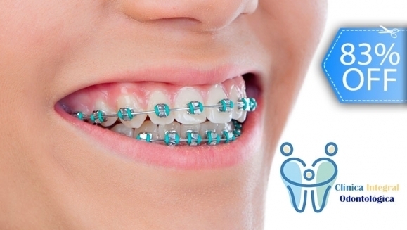 [Imagen:¡Paga Q499 en Lugar de Q3,000 por Colocación de Mini-Brackets Metálicos (Superiores e Inferiores) + Evaluación y Diagnóstico Clínico + Profilaxis Dental + Fotografías + Kit de Limpieza Completo!]