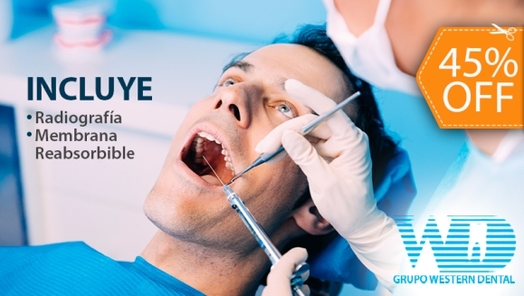 [Imagen:¡Paga $150 en Lugar de $275 por Cirugía o Extracción de Cordal + Radiografía + Membrana Reabsorbible + Antiinflamatorio Inyectado Pre Quirúrgico + Consulta de Evaluación + Limpieza con Ultrasonido + Consulta Ortodóntica + Consulta Postoperatoria!]