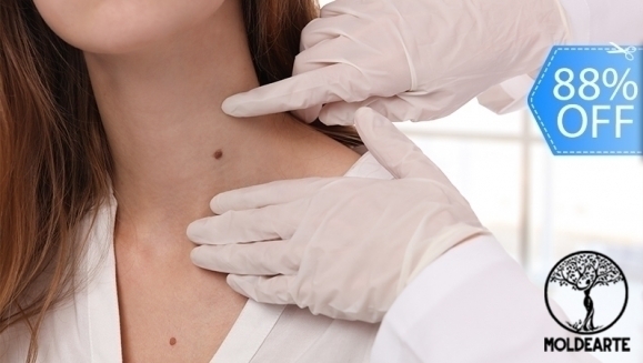 [Imagen:¡Paga Q75 en Lugar de Q650 por Cauterización Láser de Hasta 20 Cabezas de Vena, 4 Lunares o 4 Verrugas (de hasta 5 mm) + Evaluación Médica!]