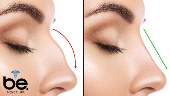 [Imagen:¡Paga Q1,999 en Lugar de Q11,000 por Rinomodelación o Rejuvenecimiento Facial con Ácido Hialurónico + PRP + 1 Limpieza Facial Profunda + Microdermoabrasión + 1 Sesión de Lipólisis QUEMA GRASA CORPORAL!]