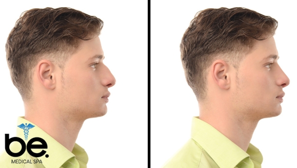 [Imagen:¡Paga Q1,999 en Lugar de Q11,000 por Rinomodelación o Rejuvenecimiento Facial con Ácido Hialurónico + PRP + 1 Limpieza Facial Profunda + Microdermoabrasión + 1 Sesión de Lipólisis QUEMA GRASA CORPORAL!]