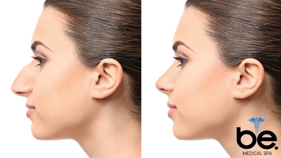 [Imagen:¡Paga Q1,999 en Lugar de Q11,000 por Rinomodelación o Rejuvenecimiento Facial con Ácido Hialurónico + PRP + 1 Limpieza Facial Profunda + Microdermoabrasión + 1 Sesión de Lipólisis QUEMA GRASA CORPORAL!]