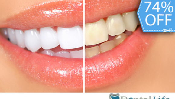 [Imagen:¡Paga Q395 en lugar de Q1,500 por Blanqueamiento Dental Láser + Limpieza y Pulido Dental con Profilaxis + Eliminación de Sarro con Ultrasonido + Aplicación Tópica de Flúor + Examen Diagnóstico en Dental Life!]