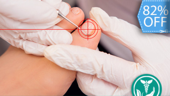 [Imagen:¡Libérate de los Hongos en las Uñas!¡Paga Q175 en lugar de Q999 por Tratamiento Láser para Hongos en las Uñas + Examen Diagnóstico + Recomendaciones y Recetas Post Tratamiento en Clínica Biológica!]