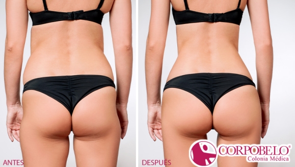 [Imagen:¡Paga $24 en Lugar de $200 por 28 Tratamientos para Moldear, Levantar y Tonificar Glúteos: 4 Levantamientos + 4 Rellenos + 4 Redondeos + 4 Tonificadores + 4 Moldeos de Espalda + 4 Moldeos de Cintura + 4 Alisamientos de Piel!]