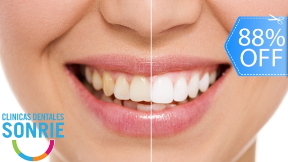 [Imagen:¡Paga Q449 en Lugar de Q3,598 por Blanqueamiento Dental con Luz LED + Limpieza Ultrasónica Profunda con Eliminación de Sarro y de Manchas de Colorantes con Pulido Profiject + Diagnóstico Integral Completo con Radiografías y Fotografías Digitales!]