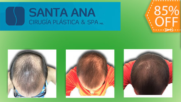 [Imagen:¡Libérate YA de la pérdida de cabello! ¡Paga $200 en vez de $1350 por 3 Sesiones de Plasma Rico en Plaquetas para Alopecia (Calvicie) en Santa Ana Cirugía Plástica y Spa!]