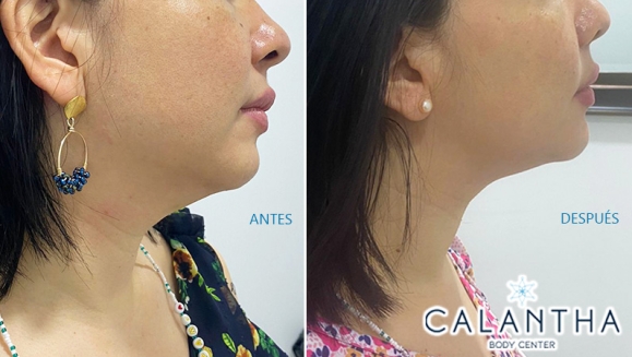 [Imagen:¡Paga $99 en Lugar de $420 por 3 Sesiones para Reducción de Papada con: 3 Infiltraciones Múltiples con Cóctel de Enzimas + 3 Radiofrecuencias + 3 Masajes Linfáticos + Evaluación Médica!]