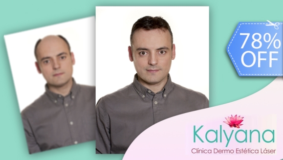 [Imagen:¡Libérate YA de la Calvicie! ¡Paga Q699 en vez de Q3,125 por Paquete para Alopecia que incluye: 1 Sesión de Plasma Rico en Plaquetas + 2 Sesiones de Carboxiterapia + 1 Sesión de Luz LED roja en Clínica Dermatológica Kalyana!]