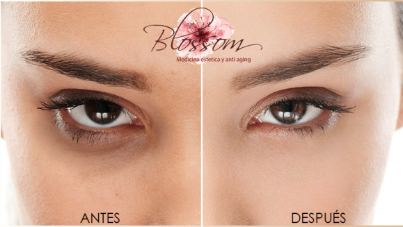 [Imagen:¡Paga Q150 en lugar de Q750 por Reducción de Ojeras y Bolsas en Los Ojos con Terapia Intradérmica!]