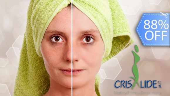 [Imagen:¡Paga Q99 en vez de Q850 por Limpieza Facial Clínica con: Peeling Hidratante con Ácido Lactobiónico + Vaporización de Ozono + Extracción de Puntos + Alta Frecuencia + Electroporación con Aceites Personalizados + Mascarilla y Más en Crisalide!]