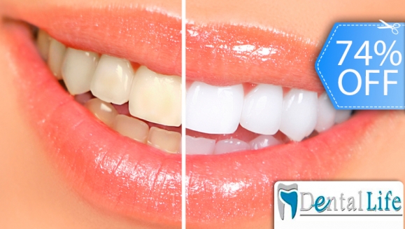 [Imagen:¡Paga Q395 en vez de Q1,500 por Blanqueamiento Dental Láser + Limpieza y Pulido Dental con Profilaxis + Eliminación de Sarro con Ultrasonido + Aplicación Tópica de Flúor + Examen Diagnóstico en Dental Life!]