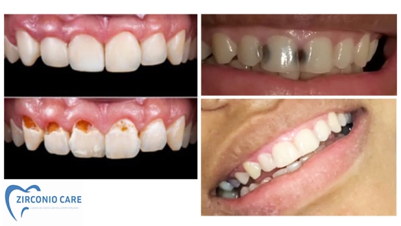 [Imagen:¡Paga $25 en Lugar de $210 por Reconstrucción Mínimamente Invasiva de 4 Dientes Frontales + Consulta General + Limpieza Dental + Aplicación Tópica de Flúor + Férula + Estuche!]