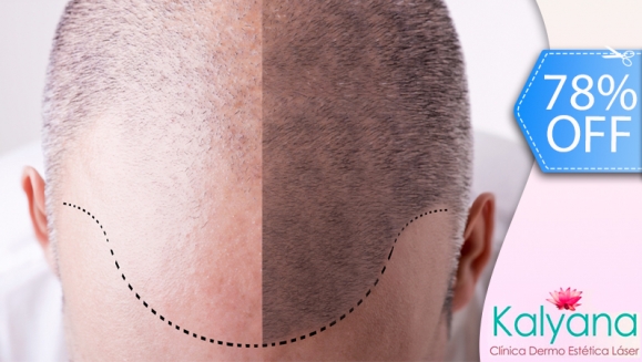 [Imagen:¡Libérate YA de la Calvicie! ¡Paga Q699 en vez de Q3,125 por Paquete para Alopecia que incluye: 1 Sesión de Plasma Rico en Plaquetas + 2 Sesiones de Carboxiterapia + 1 Sesión de Luz LED roja en Clínica Dermatológica Kalyana!]