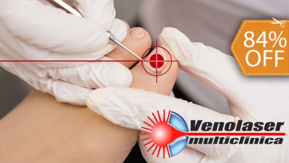 [Imagen:¡Elimina los Hongos YA! ¡Paga $39 en vez de $250 por Tratamiento Láser de 1 Sesión para 2 Uñas con Hongos en Venolaser!]