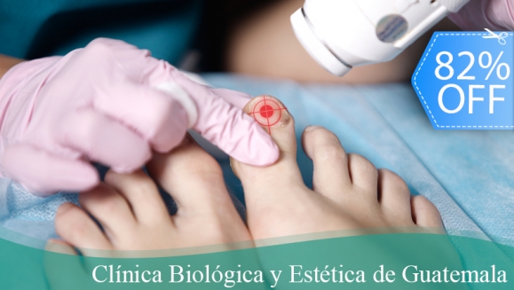 [Imagen:¡Paga Q185 en vez de Q1,040 por Tratamiento Láser contra Hongos para 2 Uñas + Laca-Anti Onicomicosis + Evaluación Médica y Más en Clínica Biológica y Estética de Guatemala!]