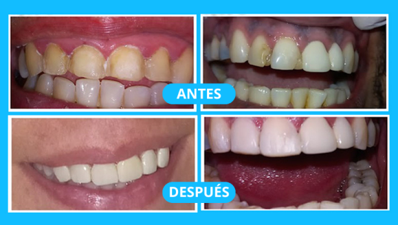 [Imagen:¡Logra una sonrisa perfecta! Paga $25 en lugar de $125 por Diseño de Sonrisa con: Carilla Dental de Resina Nano Híbrida de Porcelana y Zirconio!]