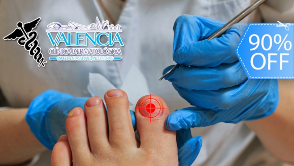 [Imagen:¡Elimina los Hongos de las Uñas YA! ¡Paga Q75 en lugar de Q750 por Sesión Láser para Hongos en 1 Uña en Valencia Clínica Dermatológica!]