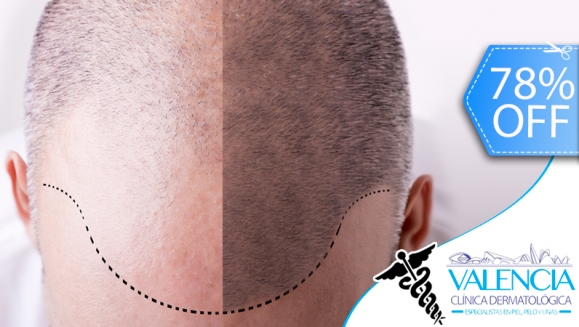 [Imagen:¡Libérate de la Calvicie YA! ¡Paga Q699 en lugar de Q3,125 por Paquete para Alopecia que Incluye: 1 Sesión de Plasma Rico en Plaquetas + 2 Sesiones de Carboxiterapia + 1 Sesión de Luz LED Roja en Valencia Clínica Dermatológica!]