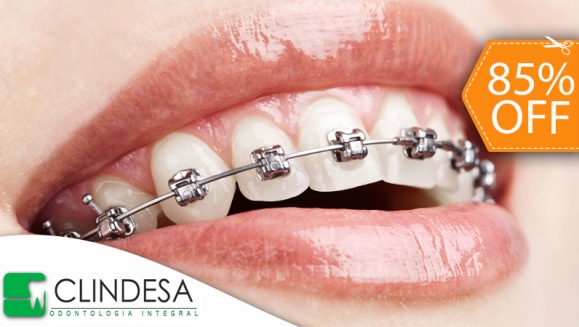 [Imagen:¡Paga $85 en lugar de $550 por Colocación de Mini-Brackets Metálicos + Evaluación y Diagnóstico Odontológico en Clínicas Clindesa!]