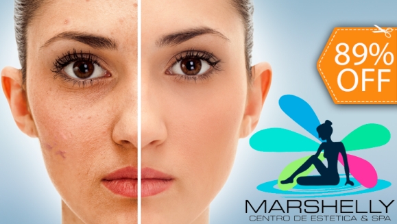 [Imagen:¡Paga $99 en lugar de $940 por Tratamiento Facial Láser Anti-edad, Anti-manchas y Anti-acné que Incluye: 2 Limpiezas Profundas + 1 Facial Ionizado + 6 Sesiones de Láser + 2 Inyectables de Ácido Hiáluronico en Marshelly!]