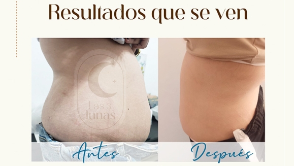 [Imagen:¡Paga $25 en Lugar de $200 por 27 Tratamientos para Reducir Tallas, Moldear y Tonificar: 4 Ultracavitaciones + 4 Wrapping de Alga Marina + 4 Lipoláser + 4 Moldeos + 4 Bambú Terapia + 4 Vibro Terapia + 3 Electroestimulación y Más!]