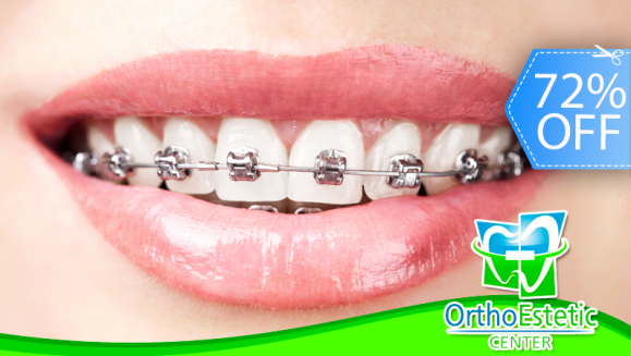 [Imagen:¡Paga Q499 en lugar de Q1,800 por Colocación de Brackets Metálicos (Superiores e Inferiores) + Evaluación y Diagnóstico Clínico + Fotografías en Ortho Estetic!]