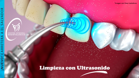 [Imagen:¡Paga Q85 en lugar de Q500 por Limpieza Dental con Ultrasonido + Pulido Dental con Profijet + Aplicación de Flúor + Examen de Diagnóstico con Radiografías Digitales!]