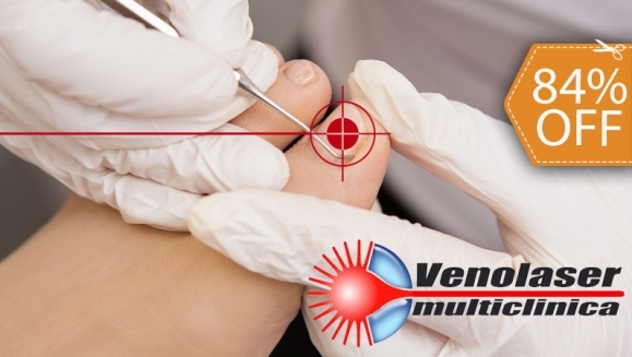 [Imagen:¡Paga $39 en vez de $250 por Tratamiento Láser de 1 Sesión para 2 Uñas con Hongos en Venolaser!]