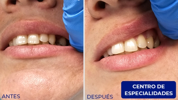 [Imagen:¡Paga $250 en Lugar de $550 por Prótesis Dental Unilateral Removible (hasta 5 Dientes) + Diagnóstico y Evaluación con Cámara Intraoral + Limpieza con Ultrasonido + Pulido Dental + Aplicación de Flúor + 2 Sellantes + Evaluación de Cordales!]