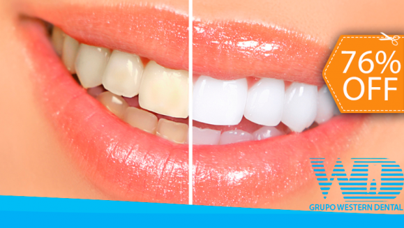 [Imagen:¡Paga $79 en vez de $325 por 1 Sesión de Blanqueamiento Dental EXTREMO con sistema ZOOM + Limpieza con Ultrasonido en la Lujosa Sala VIP de Western Dental San Benito!]