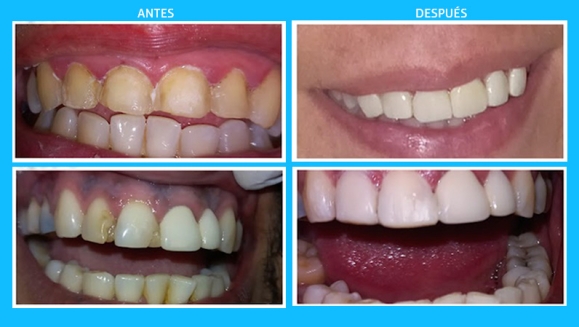 [Imagen:¡Paga $25 en lugar de $75 por Reconstrucción De Dientes Frontales que Incluye: 2 Carillas Dentales de Resina Nano Híbrida de Porcelana y Zirconio + Limpieza Dental con Ultrasonido + Aplicación de Flúor!]