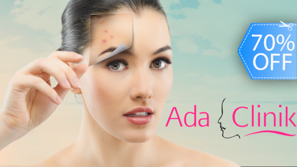 [Imagen:¡Paga Q89 en lugar de Q300 por Facial Anti-Acné que Incluye: Limpieza Facial Profunda + Desinfección de Rostro + Peeling Médico en Ada Clinik!]