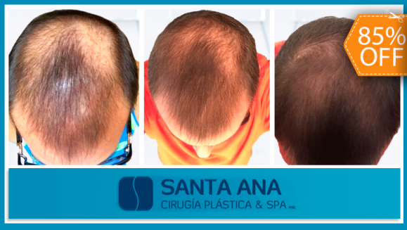 [Imagen:¡Libérate YA de la pérdida de cabello! ¡Paga $200 en vez de $1350 por 3 Sesiones de Plasma Rico en Plaquetas para Alopecia con Factores de Crecimiento en Santa Ana Cirugía Plástica y Spa!]