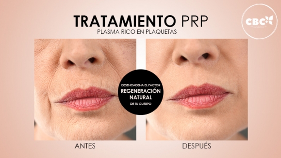 [Imagen:¡Paga $199 en Lugar de $740 por 3 Sesiones de Plasma Rico en Plaquetas para Calvicie o Rejuvenecimiento Facial + 3 Limpiezas de Rostro + 3 Mascarillas de Ozono o Carbón Activado + 3 Microneedling + 6 Mascarillas Vampiro con Colágeno Puro y Más!]