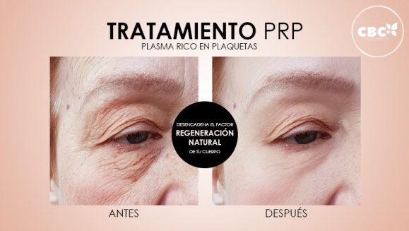 [Imagen:¡Paga $199 en Lugar de $740 por 3 Sesiones de Plasma Rico en Plaquetas para Calvicie o Rejuvenecimiento Facial + 3 Limpiezas de Rostro + 3 Mascarillas de Ozono o Carbón Activado + 3 Microneedling + 6 Mascarillas Vampiro con Colágeno Puro y Más!]