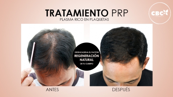 [Imagen:¡Paga $199 en Lugar de $740 por 3 Sesiones de Plasma Rico en Plaquetas para Calvicie o Rejuvenecimiento Facial + 3 Limpiezas de Rostro + 3 Mascarillas de Ozono o Carbón Activado + 3 Microneedling + 6 Mascarillas Vampiro con Colágeno Puro y Más!]