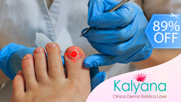 [Imagen:¡Paga Q85 en lugar de Q750 por Sesión Láser para Hongos en 1 Uña en Clínica Dermatológica Kalyana!]