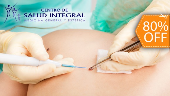 [Imagen:¡Paga $20 en lugar de $100 por Electro-Cauterización de Hasta 10 Verrugas, Lunares o Mezquinos!]