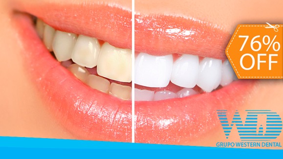[Imagen:¡Paga $79 en vez de $325 por 1 Sesión de Blanqueamiento Dental EXTREMO con sistema ZOOM + Limpieza con Ultrasonido!]