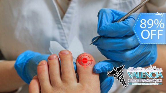 [Imagen:¡Paga Q85 en lugar de Q750 por Sesión Láser para Eliminar Hongos en 1 Uña, Evaluación y Más!]